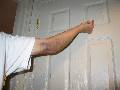 contusion