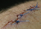 Blue stitches. Who knew?