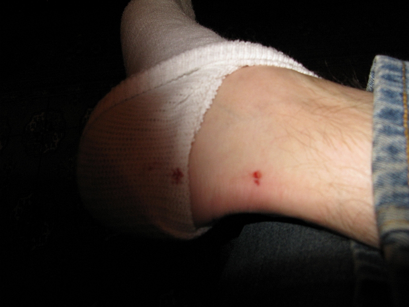 IMG_0039.JPG - Ankle. Bite.