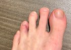IMG 6168  Why is that toe bruised? And why does it feel like it might be broken. It was fine when I went to bed the night before. Gout flare up is the leading theory. It was fine again two days later after taking Aleve.