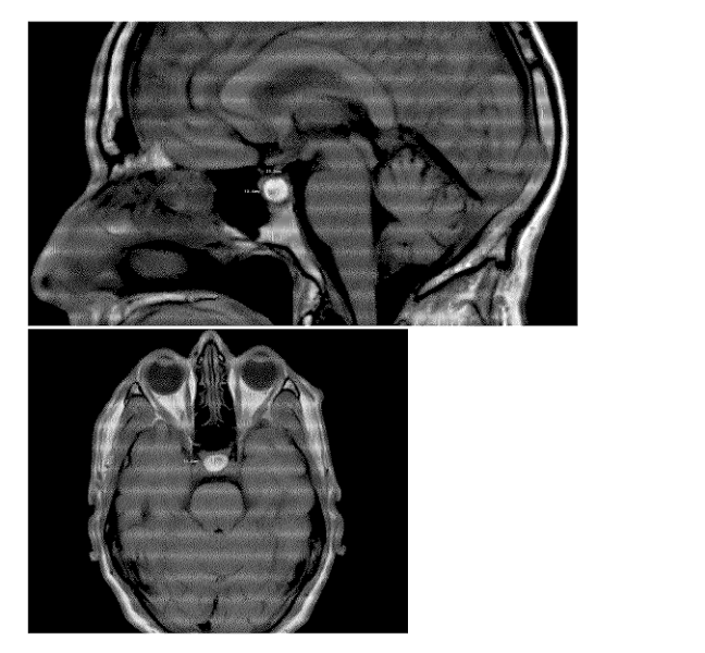 MRI result